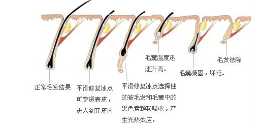 激光脱毛原理图