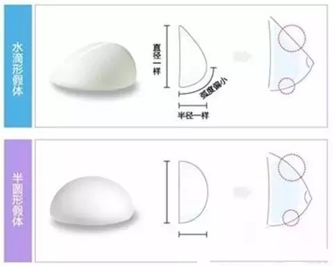 假体丰胸抛掉胸小的烦恼